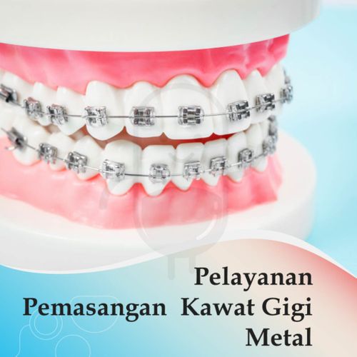 PEMASANGAN KAWAT GIGI METAL - KLINIK ALYSSA MEDIKA